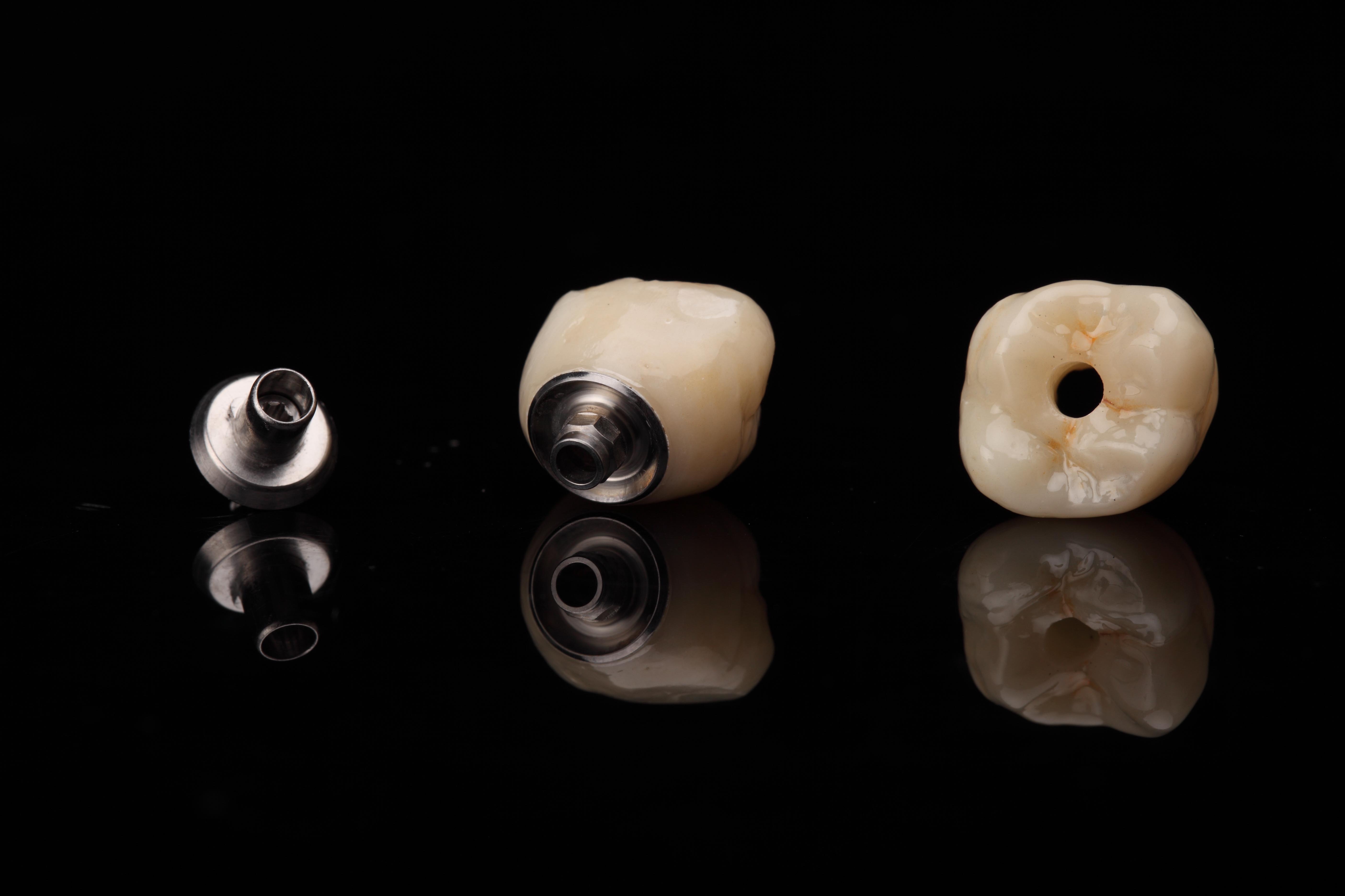 关于嵌体修复与传统补牙、全冠修复的对比 - 知乎
