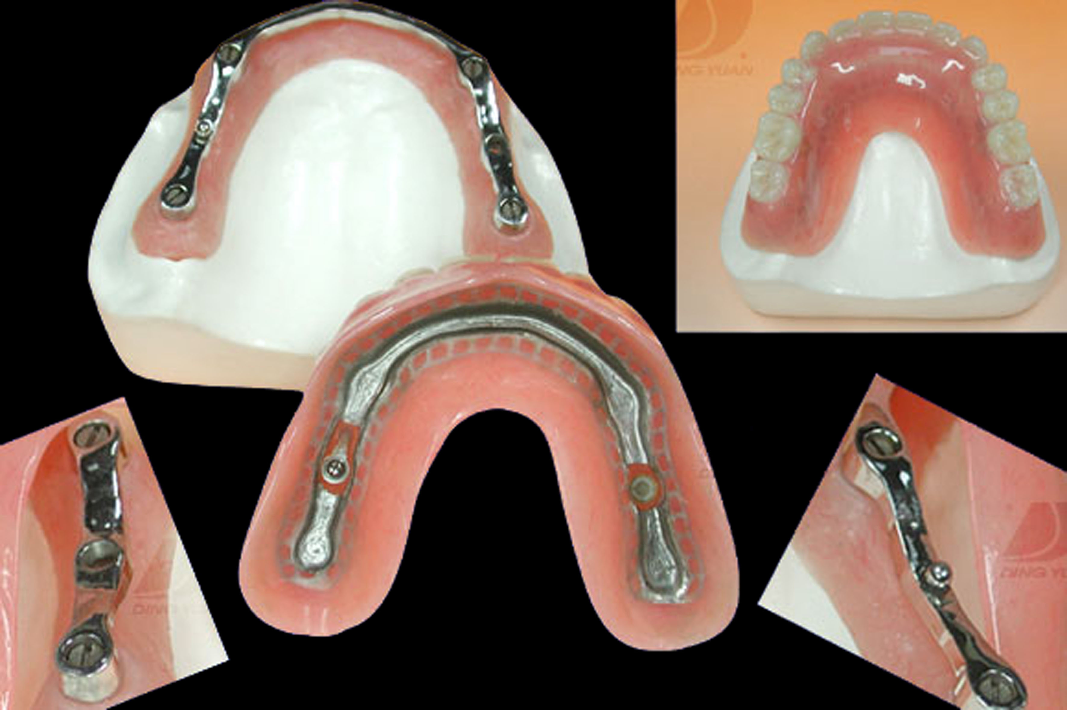 数字化种植临时修复体在美学区种植修复中的应用-瑞佳义齿